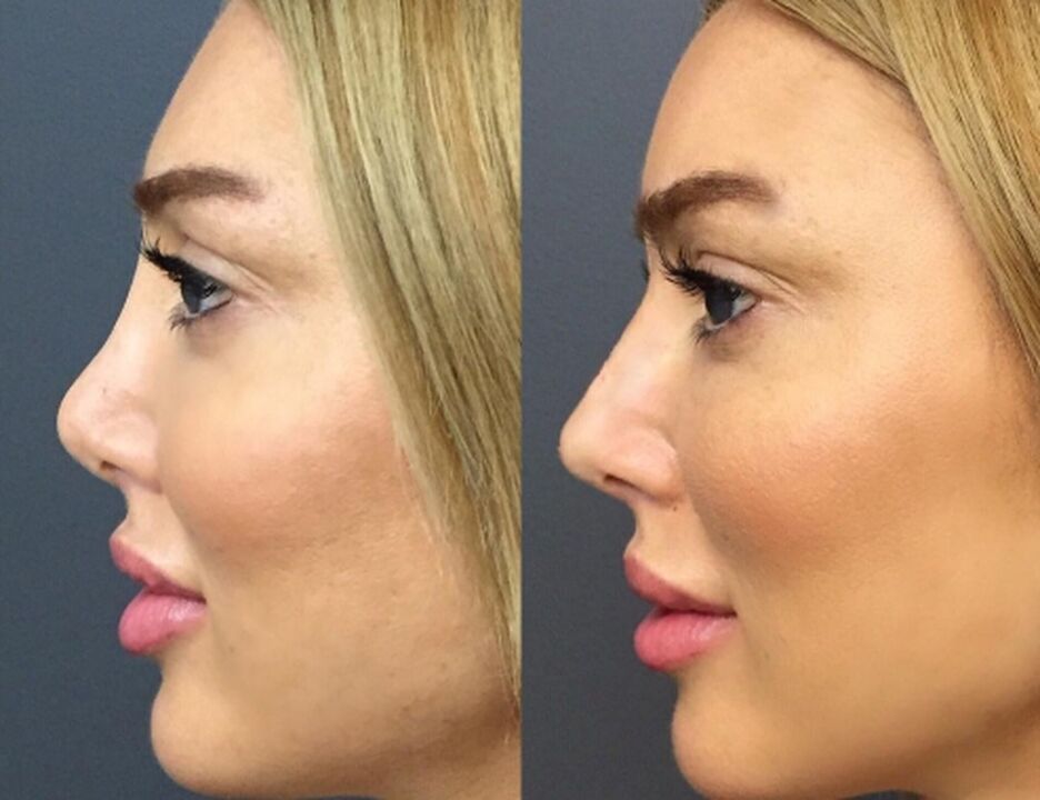 Nasal sculpture