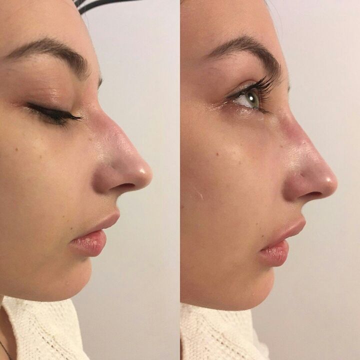 Nose correction