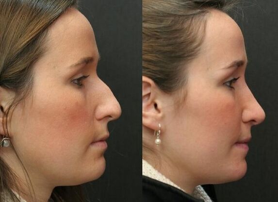 Before and after non -surgical nose correction