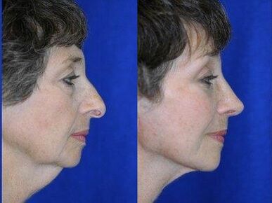 Large nostrils