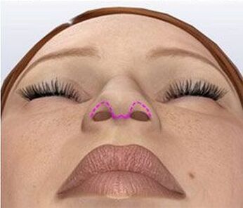 Nose correction