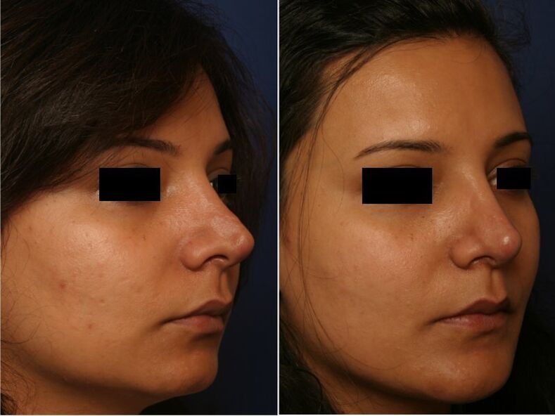 Result of plastic surgery