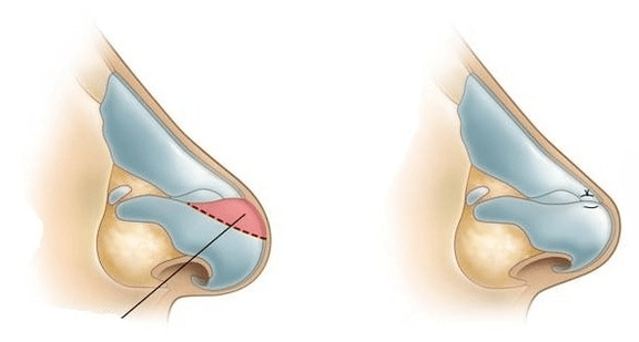 Correction of the shape of the nose