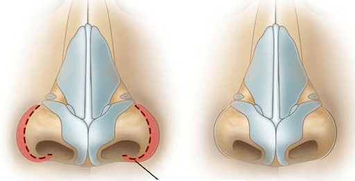 Reduction of the nostrils