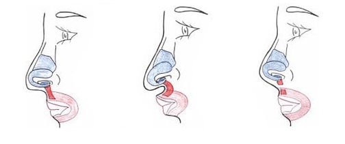 Shortening of part of the nasal muscle