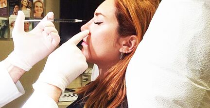 Rhinoplasty with fillers