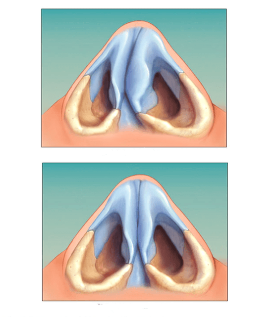 corrected nasal septum