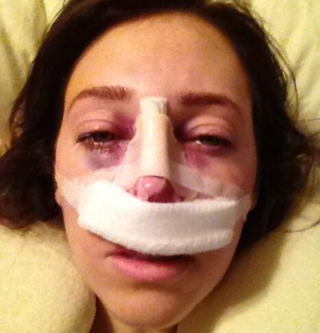 After the operation, a plaster cast is placed around the nose