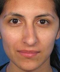 An irregular nose shape is a reason for plastic surgery