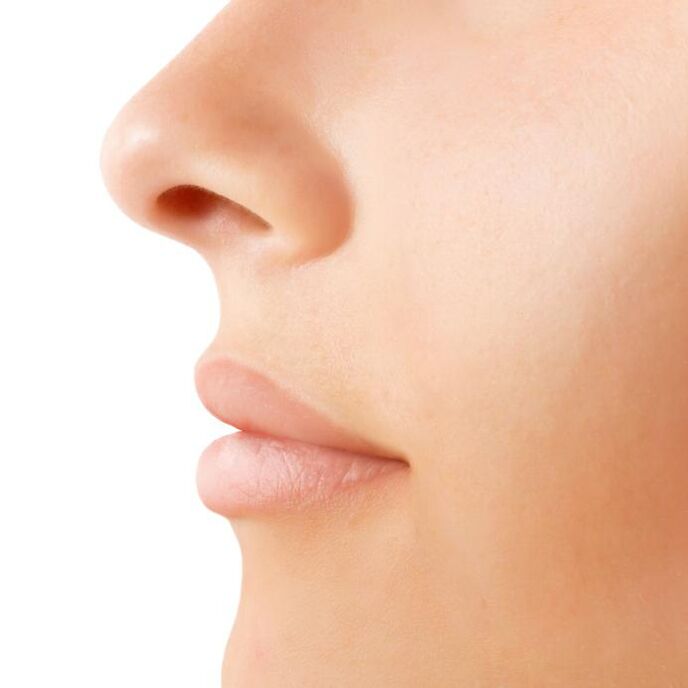 Result of an open rhinoplasty