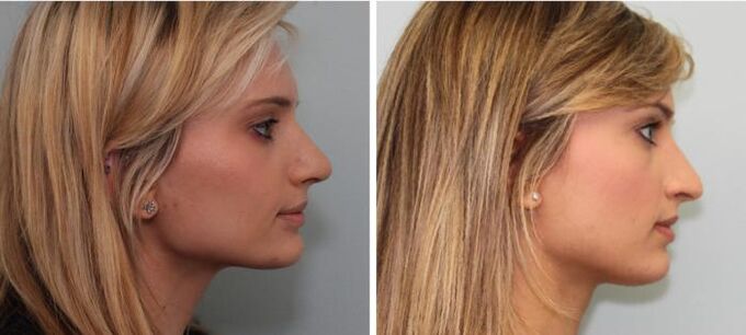 Rhinoplasty results before and after