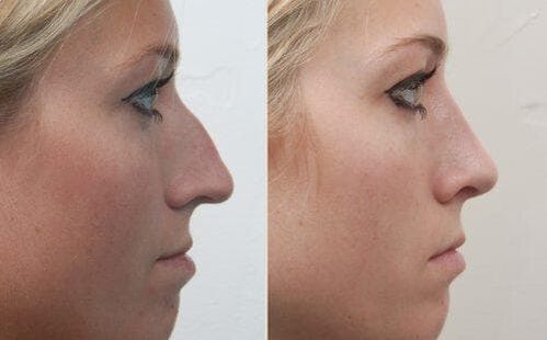 Before and after non-surgical rhinoplasty