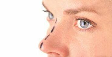 Marking on the nose for inserting cosmetic threads