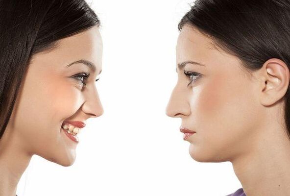 Results of the rhinoplasty