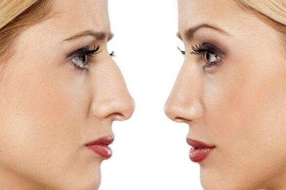 Rhinoplasty of the nose to remove humps