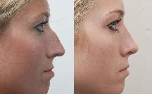 the result of a nose job