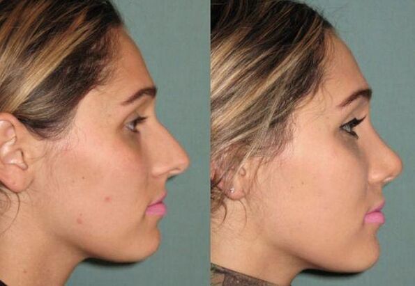 the result of an uninjected rhinoplasty
