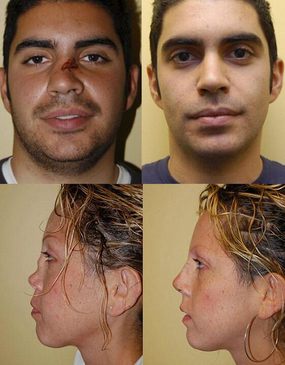 Photos before and after the rhinoplasty
