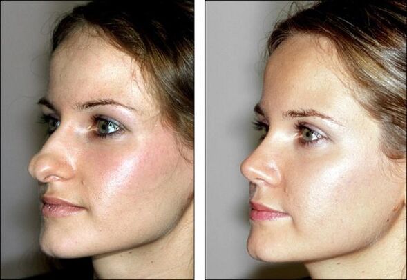 Photos before and after the rhinoplasty