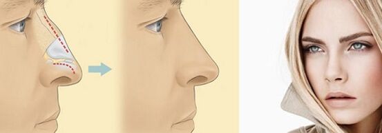 Correction of the shape of the nose with nonsurgical rhinoplasty