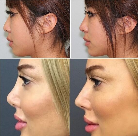Photos before and after nonsurgical rhinoplasty