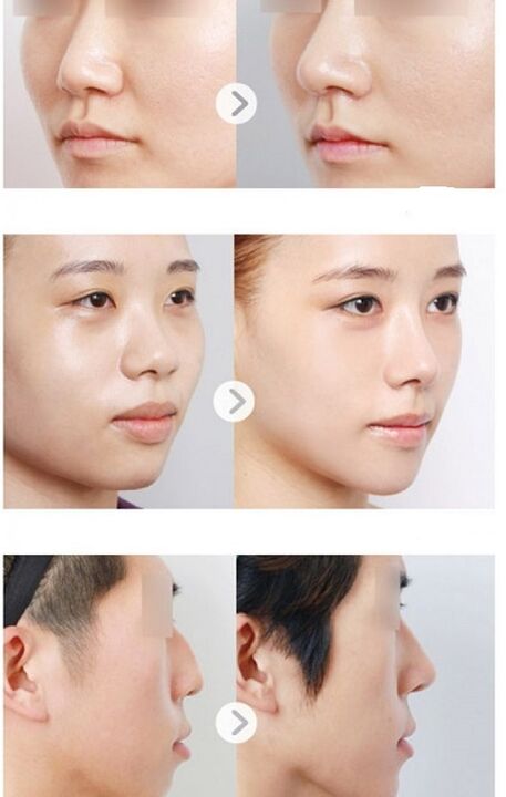 before and after nonsurgical rhinoplasty