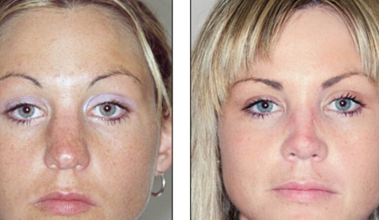 Before and after a failed rhinoplasty