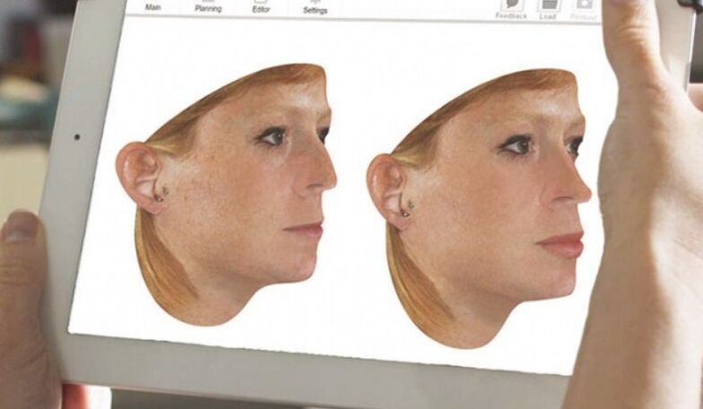 Method of computer modeling of the nose before rhinoplasty