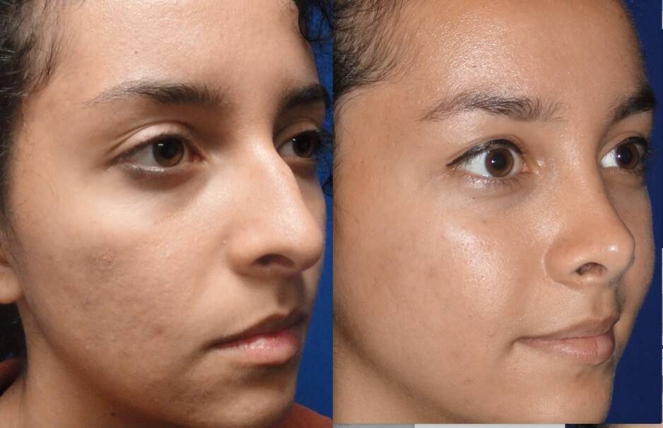 Closed rhinoplasty before and after photos