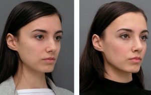 Girls before and after rhinoplasty nose