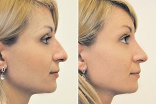 Non-invasive nose surgery, photos before and after